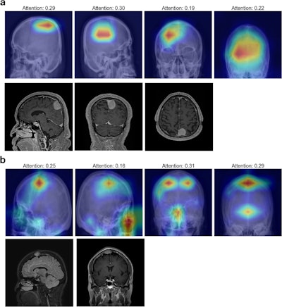 Grad-CAM Visualizations for clinoid and tuberculum sellae meningiomas from the internal dataset. (a): Grad-CAM heatmaps for clinoid meningioma display dispersed activations, with reduced localization to the clinoid region, indicating limitations in explainability despite accurate model predictions. (b): For tuberculum sellae meningioma, activation maps show scattered and weakly localized activations, highlighting challenges in visual explainability for deeper anatomical regions.