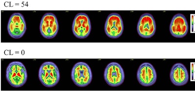 Axial color scales images of two brains show examples of an amyloid positive scan with a higher centiloid (CL) number and more red colors compared to a normal scan with normal background binding of the amyloid tracer signifying no amyloid plaques.