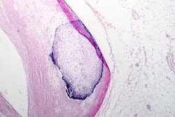 Artery Calcification Adobe Dr Microbe