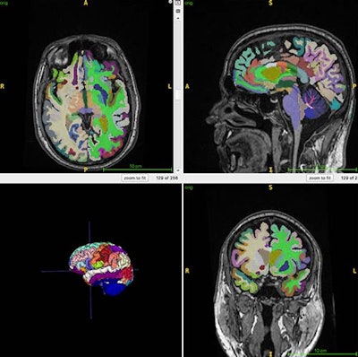 This color-coded brain figure shows an example of segmented regional volumes obtained from the 3D T1 volumetric MRI scans used for the artificial intelligence (AI) computations of brain age used in this study.