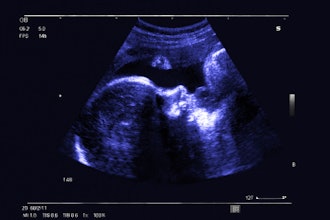 Fetal Ultrasound
