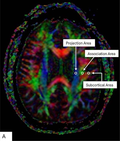 Color display of diffusion tensor imaging indicating the distribution of projection fibers (z-axis: blue), association fibers (y-axis: green), and the subcortical fibers (x-axis: red). Three regions of interest are placed in the area with projection fibers (projection area), association fibers (association area), and subcortical fibers (subcortical area) to measure diffusivities of the three directions (x, y, z).