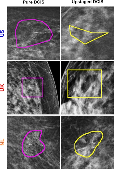 Examples of correctly predicted lesions among three countries using the model trained on images from the U.S. dataset. Lesion annotations were provided by the study radiologists at each site. The regions of interest indicate lesion annotations.