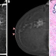 Preoperative CEM images in a 73-year-old female patient show true-positive findings of a non-luminal ERBB2-positive (formerly HER2 or HER2/neu) grade 3 invasive carcinoma of no specific type, with a spiculated mass with high conspicuity heterogeneous mass enhancement in the posterior third of the right upper outer quadrant. An area of high conspicuity clumped nonmass enhancement with associated microcalcifications (craniocaudal view of low-energy images in A; craniocaudal view of recombined images in B) extended from the mass to the nipple-areolar complex (minimum enhancement-to-nipple distance on the craniocaudal view, 0 mm), which on a (C) photomicrograph (hematoxylin-eosin stain at ×50 magnification) was completely infiltrated by malignant epithelial cells with diffuse desmoplastic stromal reaction, consistent with tumor involvement. Three residual normal ducts (arrows in C) were still present. Aside from the continuity of the nonmass enhancement with the nipple-areolar complex, other findings at CEM that were consistent with pathologic nipple involvement were the presence of an inverted nipple type and of nipple retraction (A, B), periareolar skin thickening (arrow in A), and disruption of the superficial linear enhancement (arrowheads in B).