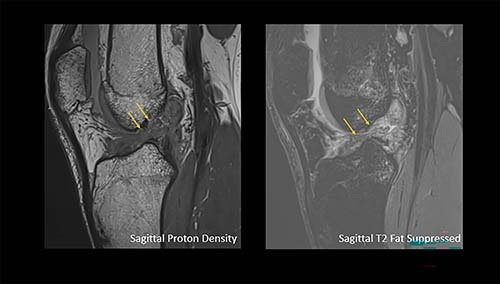 Arrows show a complete anterior cruciate ligament rupture in an 18-year-old male who had a knee injury while playing football.