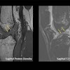 Arrows show a complete anterior cruciate ligament rupture in an 18-year-old male who had a knee injury while playing football.