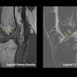Arrows show a complete anterior cruciate ligament rupture in an 18-year-old male who had a knee injury while playing football.