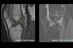 Arrows show a complete anterior cruciate ligament rupture in an 18-year-old male who had a knee injury while playing football.