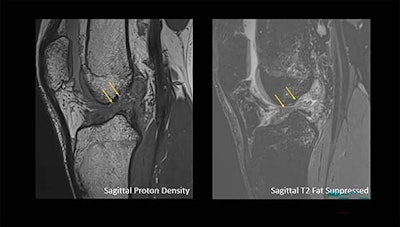 Arrows show a complete anterior cruciate ligament rupture in an 18-year-old male who had a knee injury while playing football.
