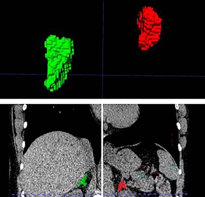 Left and right adrenal automated 2D and 3D segmentation in chest CT.