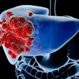 Liver Cancer