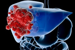 Liver Cancer