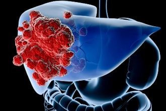 Liver Cancer