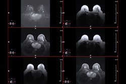 Mri Breast Cancer