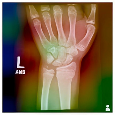 Grad-CAM heatmap of the EfficientNet-B2 model for a sample radiograph.