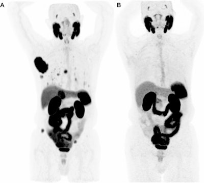 Complete response to immune checkpoint inhibitor therapy on Ga-68 PSMA-PET/CT. Maximum intensity projection (MIP) images from an 83-year-old male with metastatic HCC treated with atezolizumab and bevacizumab. (A) Baseline pretreatment image demonstrates a large, intensely PSMA-avid lesion in the right hepatic lobe, along with multiple metastatic lesions throughout the abdomen and skeleton. (B) Follow-up scan performed four months after initiating therapy shows complete resolution of PSMA uptake in all hepatic and extrahepatic disease.