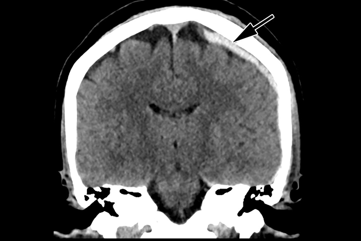 Rsna2025 Head Ct Intimate Partner Violence Fig 2 Thumbnail
