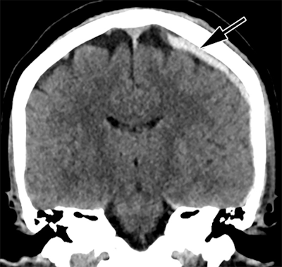 Head CT of intimate partner violence patient with left-sided parietal subdural hematoma (arrow).