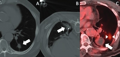 Images depict post-SBRT image-guided thermal ablation. (A) Axial CT image demonstrates a nodular recurrence of NSCLC at the site of prior SBRT in the left lower lobe (arrow). (B) Intraprocedural axial CT image shows placement of a microwave ablation probe within the recurrent tumor, with surrounding ground-glass opacity (arrow). (C) PET-CT obtained 14 months post-ablation demonstrates no significant FDG uptake within the treated lesion (arrow); however, a new site of disease is noted (between arrowheads).