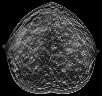 A 40-year-old patient presents for routine screening with a family history of the paternal grandmother, age 55. Extremely dense breast tissue is noted on mammography right and left craniocaudal view.