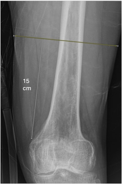 Example of how thigh muscle diameter measurements were obtained from the anteroposterior radiograph. Diameter of thigh muscle (yellow line) and diameter of whole soft tissue envelope (yellow + white lines) were measured 15 cm proximal to the adductor tubercle.