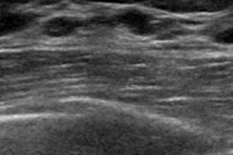 Ultrasound Breast 400