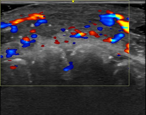 Color Doppler ultrasound shows vascular occlusion from hyaluronic acid fillers. Here, blood flow is absent in a segment of an artery on the lip.