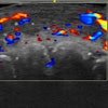 Color Doppler ultrasound shows vascular occlusion from hyaluronic acid fillers. Here, blood flow is absent in a segment of an artery on the lip.