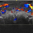 Color Doppler ultrasound shows vascular occlusion from hyaluronic acid fillers. Here, blood flow is absent in a segment of an artery on the lip.