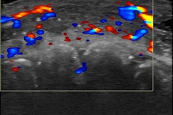 Color Doppler ultrasound shows vascular occlusion from hyaluronic acid fillers. Here, blood flow is absent in a segment of an artery on the lip.
