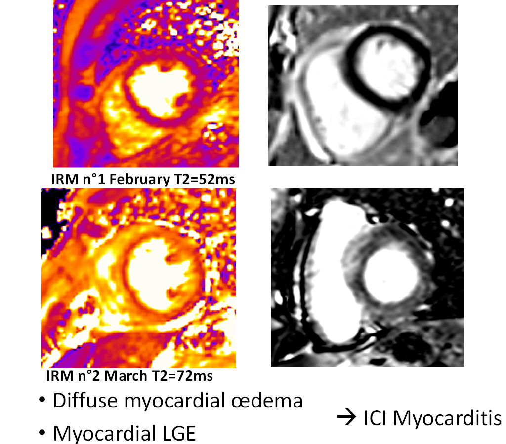 Patient with diffuse myocardial edema. Myocardial late gadolinium enhancement shows myocarditis caused by immune checkpoint inhibitors. Courtesy of Alexis Jacquier, MD.