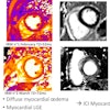 Patient with diffuse myocardial edema. Myocardial late gadolinium enhancement shows myocarditis caused by immune checkpoint inhibitors. Courtesy of Alexis Jacquier, MD.