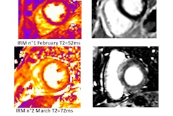 Patient with diffuse myocardial edema. Myocardial late gadolinium enhancement shows myocarditis caused by immune checkpoint inhibitors. Courtesy of Alexis Jacquier, MD.
