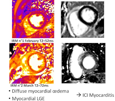 Patient with diffuse myocardial edema. Myocardial late gadolinium enhancement shows myocarditis caused by immune checkpoint inhibitors. Courtesy of Alexis Jacquier, MD.