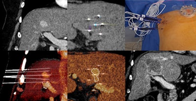 Corresponding treatment of a central hepatocellular carcinoma (HCC) shows the precision achieved with the help of the robot, even for junior practitioners. Courtesy of Laurent Milot, MD, PhD.
