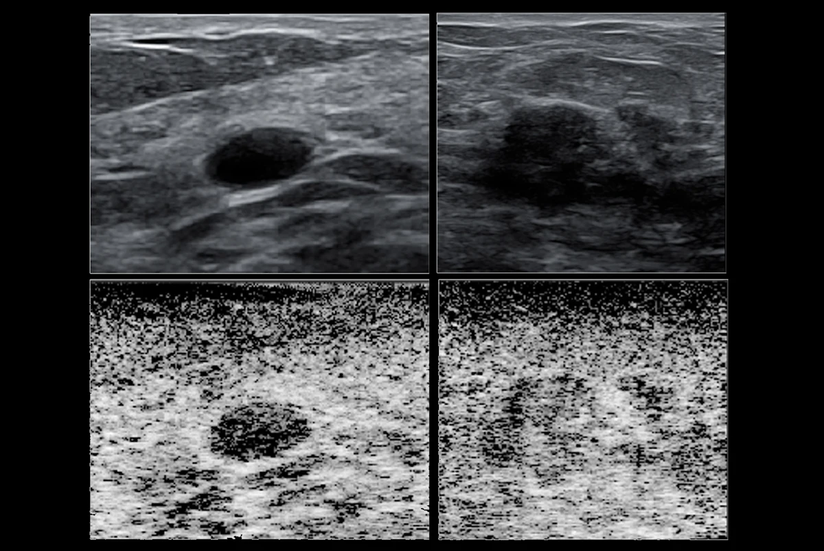 Breast Ultrasound: Reduced False Positives by 30%