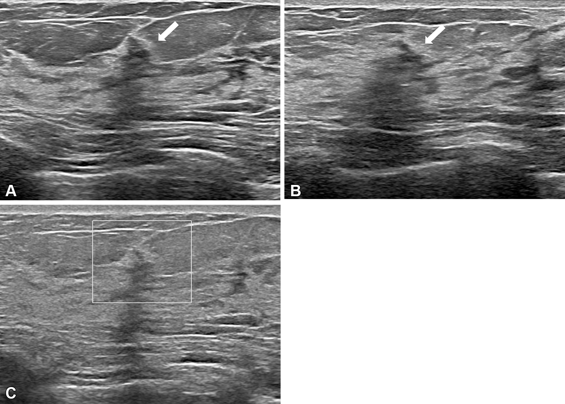 Images depict a 50-year-old woman with a lesion detected during screening ultrasound. (A) Transverse and (B) longitudinal images reveal a 0.5-cm hypoechoic lesion (arrow) in the left breast. (C) Transverse color Doppler ultrasound image does not show an increase in vascularity. Two readers classified the lesion as a mass, whereas two others categorized it as a nonmass lesion, leading to its designation as a controversial nonmass lesion. Ultrasound-guided core needle biopsy and subsequent pathologic examination confirmed a nonproliferative breast change.