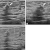 Images depict a 50-year-old woman with a lesion detected during screening ultrasound. (A) Transverse and (B) longitudinal images reveal a 0.5-cm hypoechoic lesion (arrow) in the left breast. (C) Transverse color Doppler ultrasound image does not show an increase in vascularity. Two readers classified the lesion as a mass, whereas two others categorized it as a nonmass lesion, leading to its designation as a controversial nonmass lesion. Ultrasound-guided core needle biopsy and subsequent pathologic examination confirmed a nonproliferative breast change.