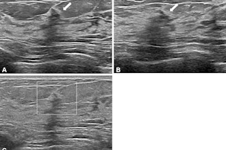 Images depict a 50-year-old woman with a lesion detected during screening ultrasound. (A) Transverse and (B) longitudinal images reveal a 0.5-cm hypoechoic lesion (arrow) in the left breast. (C) Transverse color Doppler ultrasound image does not show an increase in vascularity. Two readers classified the lesion as a mass, whereas two others categorized it as a nonmass lesion, leading to its designation as a controversial nonmass lesion. Ultrasound-guided core needle biopsy and subsequent pathologic examination confirmed a nonproliferative breast change.