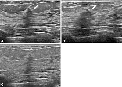 Images depict a 50-year-old woman with a lesion detected during screening ultrasound. (A) Transverse and (B) longitudinal images reveal a 0.5-cm hypoechoic lesion (arrow) in the left breast. (C) Transverse color Doppler ultrasound image does not show an increase in vascularity. Two readers classified the lesion as a mass, whereas two others categorized it as a nonmass lesion, leading to its designation as a controversial nonmass lesion. Ultrasound-guided core needle biopsy and subsequent pathologic examination confirmed a nonproliferative breast change.