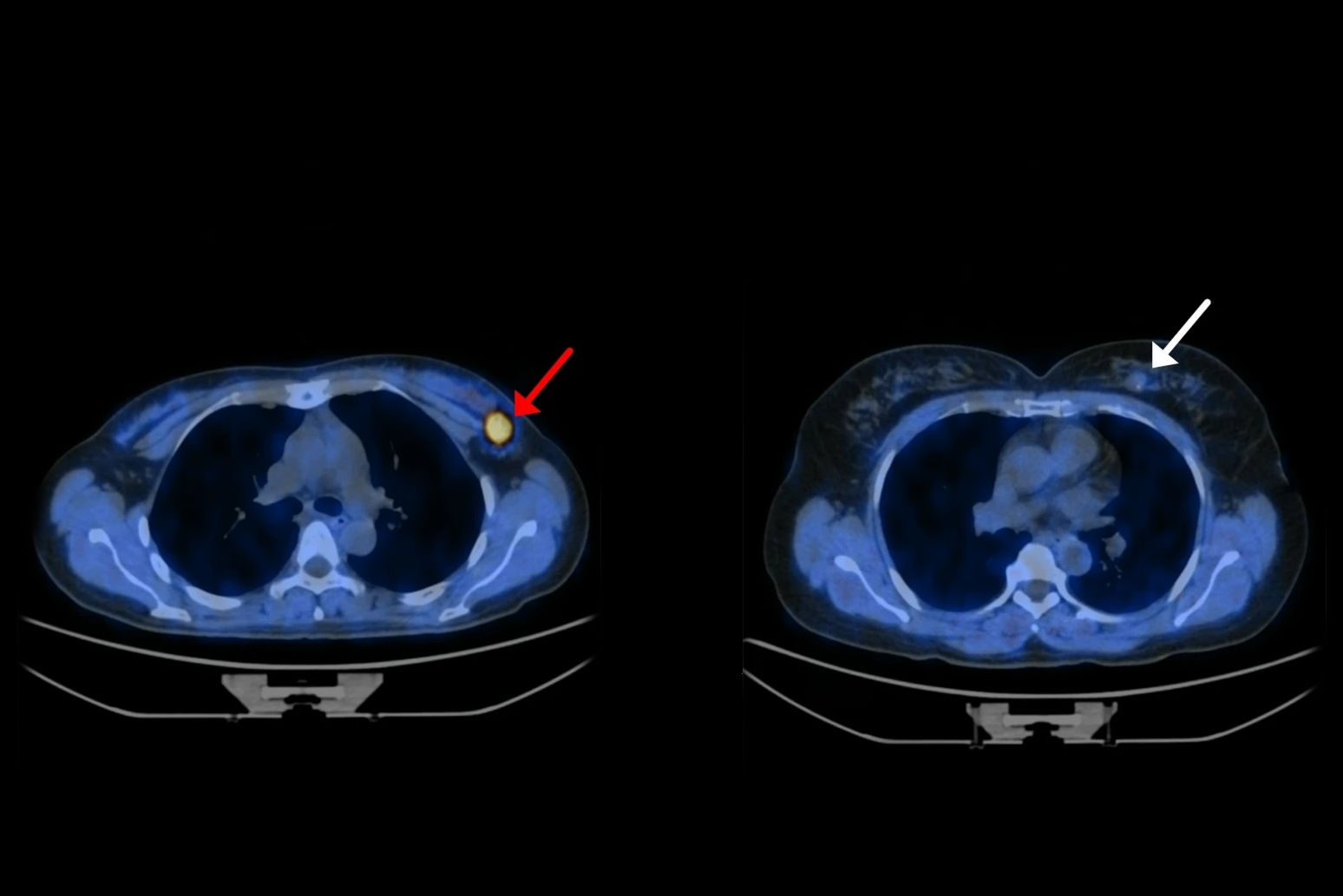 2025 12 12 Fapi Breast Cancer Thumbnail