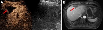 Images depict a 49-year-old male participant with hepatocellular carcinoma following downstaging therapy. (A) Transverse dual contrast-enhanced ultrasound (CEUS) image (left) and B-mode image (right) show the tumor lesion. (B) Image shows an axial contrast-enhanced MRI scan of the tumor lesion. Both CEUS and contrast-enhanced MRI reveal no evidence of residual viable tumor (arrow). Histopathologic analysis further confirmed the absence of residual viable tumor.