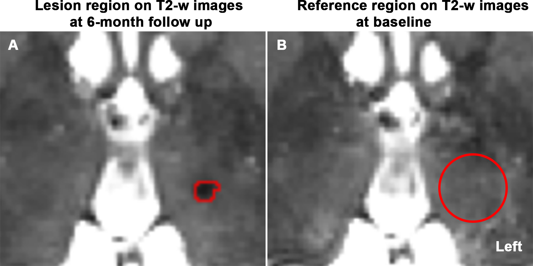 T1/T2-weighted ratio imaging improves chronic brain lesion contrast ...
