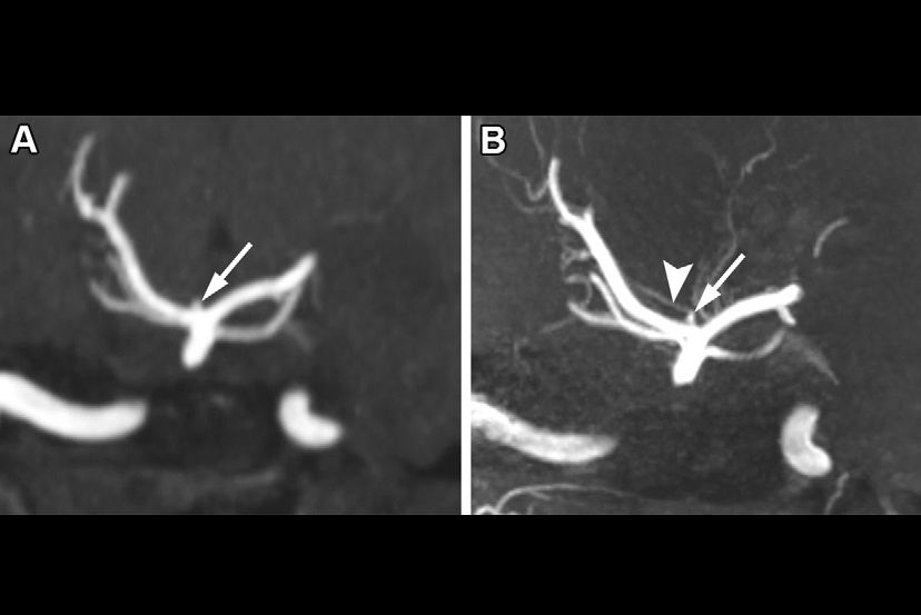 2025 12 18 Radio Graphics Seyedsaadat Fig11 Thumbnail