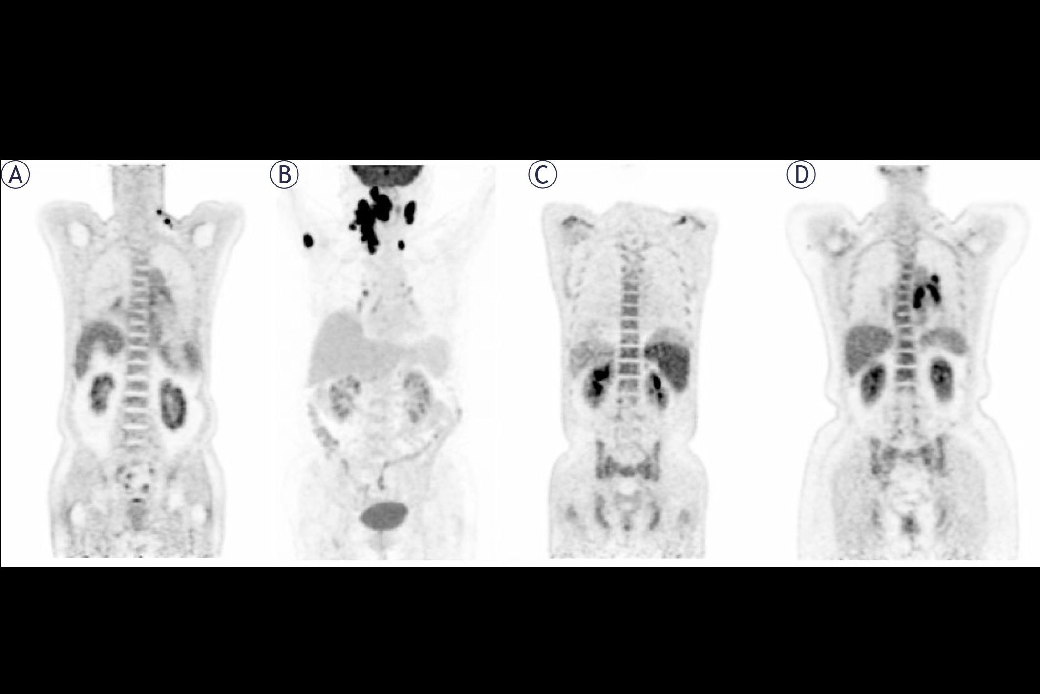 2025 12 19 Blood Cancer Thumbnail