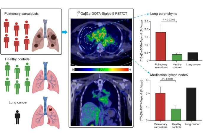 2025 12 22 Sarcoidosis Thumbnail