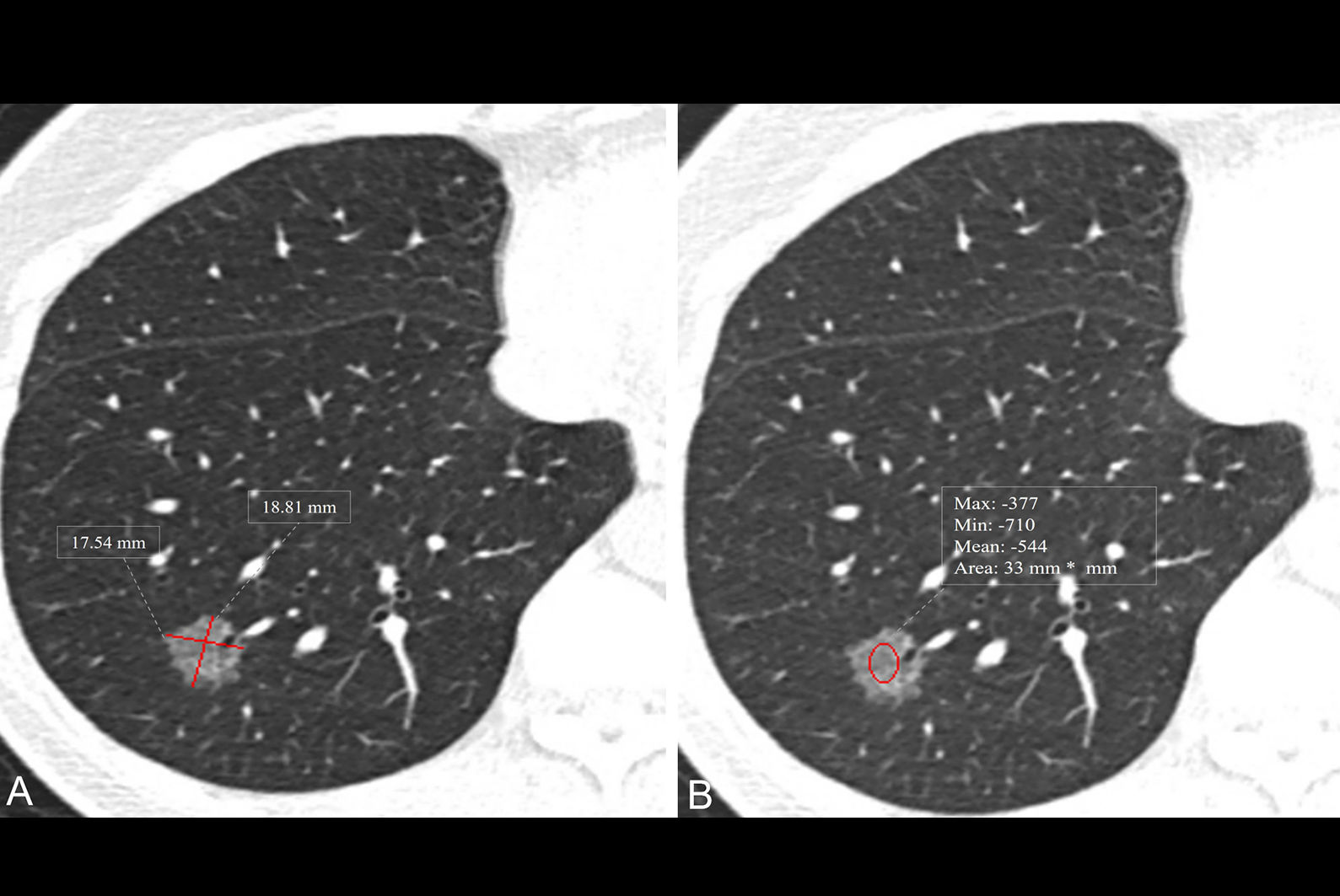 2025 12 23 Radiology Ct Lung Ternary Model Thumbnail