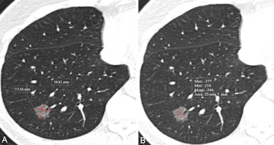 CT images show measurement of nodule size and mean CT attenuation in a 52-year-old woman. Transverse lung-window CT images were obtained without administration of contrast material. This lesion was pathologically proven to be an invasive adenocarcinoma. (A) Nodule size was measured by taking the mean of the maximum length and maximum width, defined as perpendicular to the length on the same axial image showing the maximum area of the nodule. The red lines indicate the length and width and measure 17.5 mm and 18.8 mm, respectively. (B) Nodule CT attenuation was measured by placing three regions of interest within the nodule covering two-thirds of the largest area while avoiding vessels and bronchioles. The red circle indicates CT attenuation and measures -544 HU.
