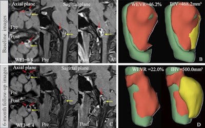 MRI reveals how statins reduce vessel wall inflammation