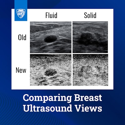 Conventional ultrasound of breast tissue (top) compared to the new method (bottom). Conventional ultrasound relies on the amplitude of signals, turning high and low signals into blacks, whites, and grays. The new method is “coherence-based,” meaning the image relies on how similar signals are to neighboring signals.
